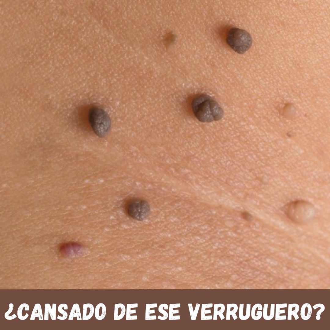 Quita Verrugas